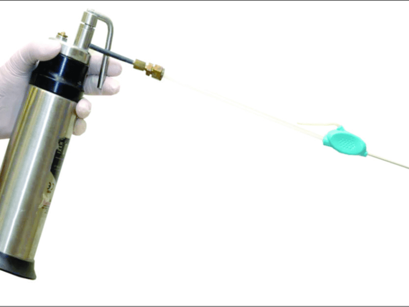 Intralesional CryoShape for the Treatment of Keloid