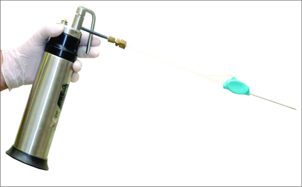 Intralesional CryoShape for the Treatment of Keloid